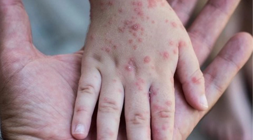 Germany Identifies Its First Case Of New Mpox Variant